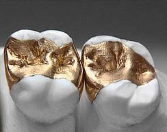 Zahnerhaltung mit Goldfüllungen Zähne mit Goldfüllung